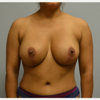 25-34 year old woman treated with Breast Lift with Implants after 3629391