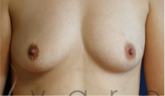 25-34 year old woman treated with Breast Augmentation before 3657009