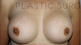 25-34 year old woman treated with Breast Augmentation after 3657009