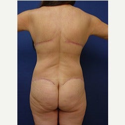55-64 year old woman treated with Body Lift after 2058166