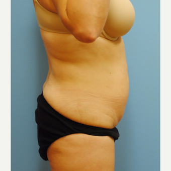 35-44 year old woman treated with Liposuction after 3069302