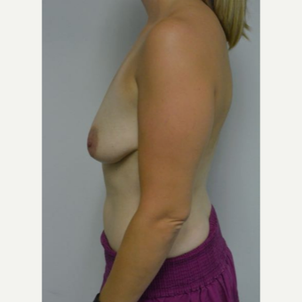 25-34 year old woman treated with Breast Lift with Implants before 3219902