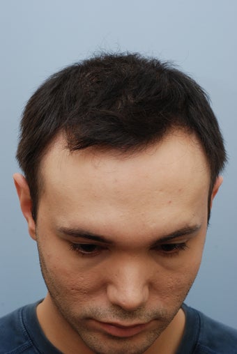 26 year old male treated for hair loss after 1094693
