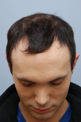 26 year old male treated for hair loss before 1094693