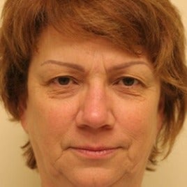 Eyelid Surgery before 1623751
