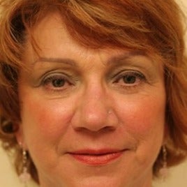 Eyelid Surgery after 1623751