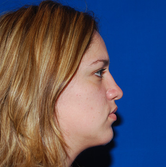 Chin Augmentation after 1284444