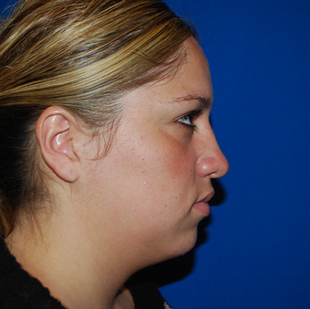 Chin Augmentation before 1284444