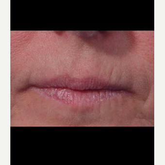 45-54 year old woman treated with Laser Treatment before 3711383