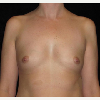 25 year old woman treated with Breast Augmentation before 3104736