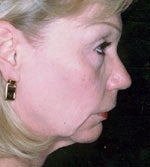 Neck Liposuction before 666944