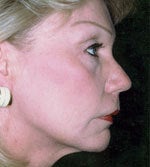 Neck Liposuction after 666944