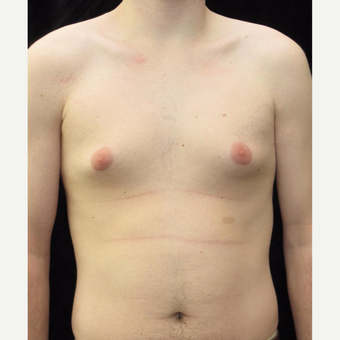21 year old man treated with Male Breast Reduction for Gynecomastia before 2702754