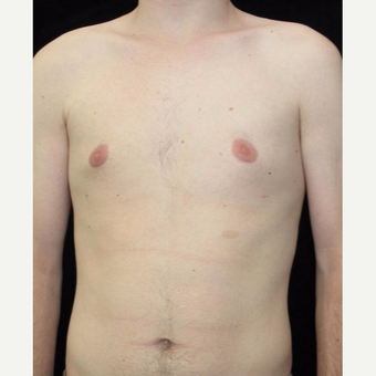 21 year old man treated with Male Breast Reduction for Gynecomastia after 2702754