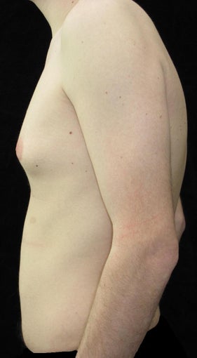 21 year old man treated with Male Breast Reduction for Gynecomastia 2702754