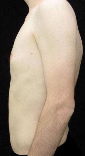 21 year old man treated with Male Breast Reduction for Gynecomastia 2702754