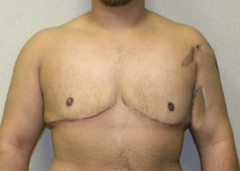 Transgender Female to Male top surgery after 1190801