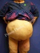 Massive Weight Loss after 1094521