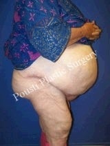 Massive Weight Loss 1094521