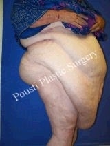 Massive Weight Loss 1094521