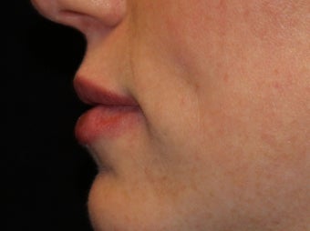 25-34 year old woman treated with Lip Augmentation 3502416