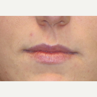 25-34 year old woman treated with Lip Augmentation before 3502416