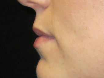 25-34 year old woman treated with Lip Augmentation 3502416