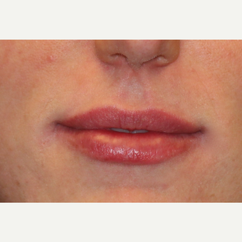 25-34 year old woman treated with Lip Augmentation after 3502416