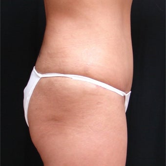 45-54 year old woman treated with Mini Tummy Tuck 1944537