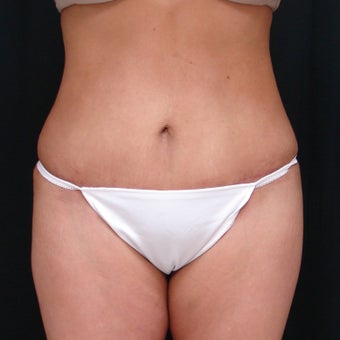 45-54 year old woman treated with Mini Tummy Tuck after 1944537
