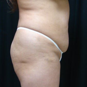 45-54 year old woman treated with Mini Tummy Tuck 1944537