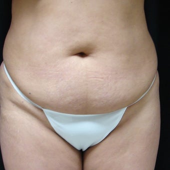 45-54 year old woman treated with Mini Tummy Tuck before 1944537