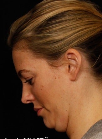 25-34 year old woman treated with Smartlipo Neck Liposuction before 3127019