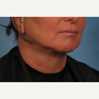 55-64 year old woman treated with Non-Surgical Neck Lift - Precision TX Laser Neck Lift after 2015572