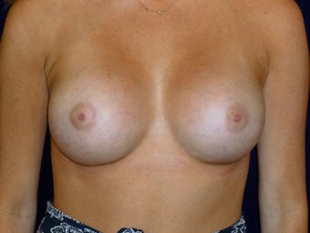Breast Augmentation after 1450718