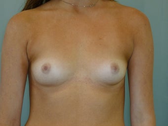 Breast Augmentation before 1450718