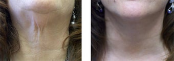 Face and Neck Lift before 220926