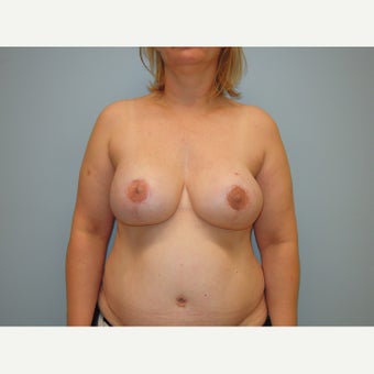 45-54 year old woman treated with Breast Reconstruction after 1871982