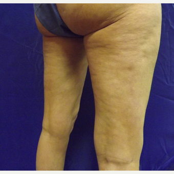 47 year old female treated with SculpSure before 2706315