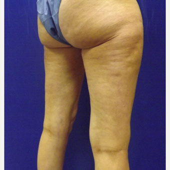 47 year old female treated with SculpSure after 2706315