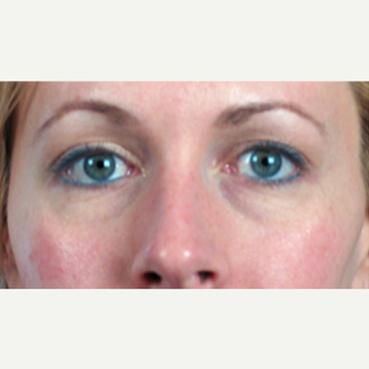35-44 year old woman treated with Eyelid Surgery before 3213249