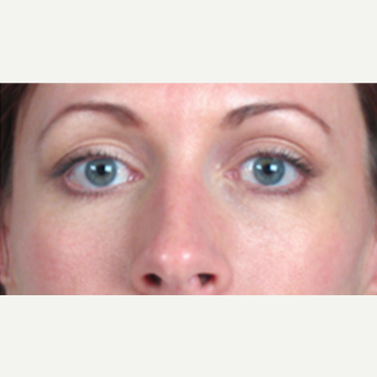 35-44 year old woman treated with Eyelid Surgery after 3213249