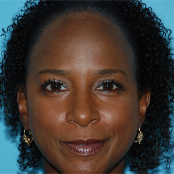 45-54 year old woman treated with Eyelid Surgery after 3168409