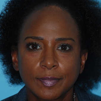 45-54 year old woman treated with Eyelid Surgery before 3168409