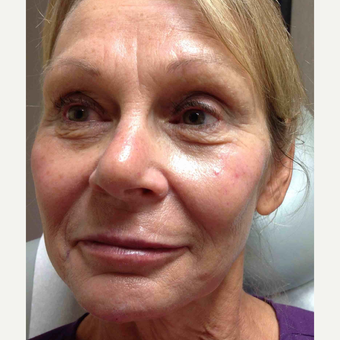 55-64 year old woman treated with Voluma after 3500523