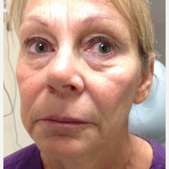 55-64 year old woman treated with Voluma before 3500523