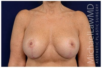 Breast Implants after 1516993
