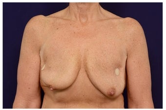 Breast Implants before 1516993