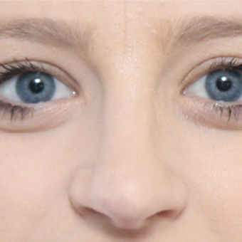 18-24 year old woman treated with Rhinoplasty after 3566054