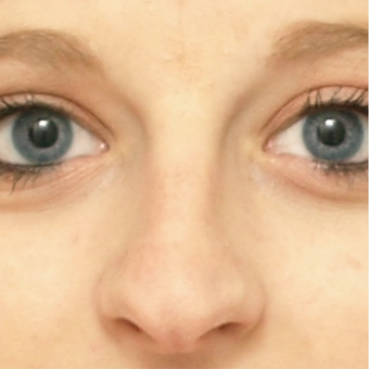18-24 year old woman treated with Rhinoplasty before 3566054